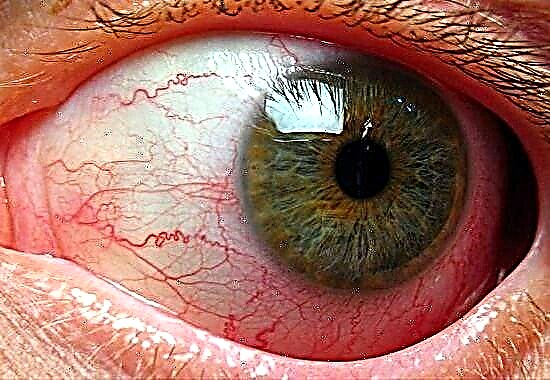 Angiopatia diabetike retinale: shkaqet e dëmtimit dhe trajtimit të syve