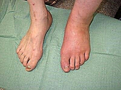 O pé de Charcot en diabetes mellitus: tratamento de complicacións e osteoartropatía diabética