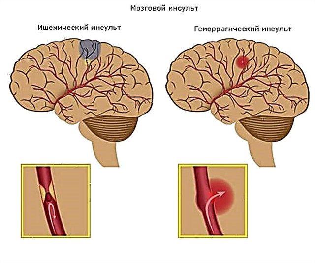 Dijabetes melitus ishemijski moždani udar: prehrana i moguće komplikacije