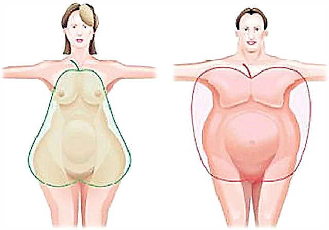 Абдоминален тип на дебелина кај жени и мажи: третман, диета