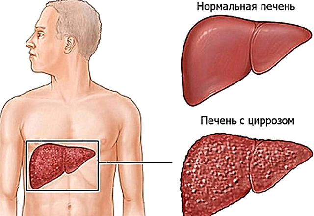 Hepato-malsanoj en diabeto: simptomoj de malsanoj (cirozo, grasa hepatosis)