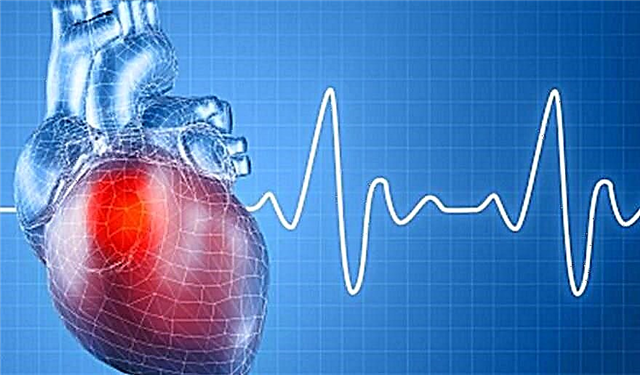 Hartsinfarkt by tipe 2-diabetes: gevolge