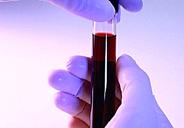 Glycohemoglobin nədir: qan testində bir yüksəliş səviyyəsinin təyin edilməsi