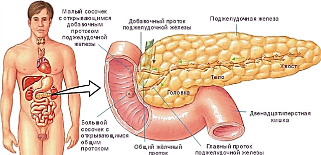 Pancreatogenic diabet mellitus