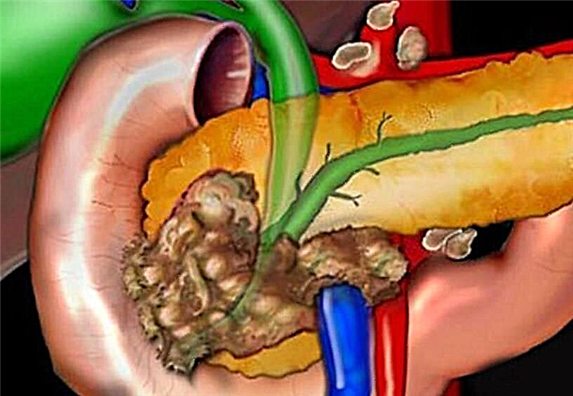 Kanker sirah pancreatic: prognosis, sabab, tanda-tanda hambalan