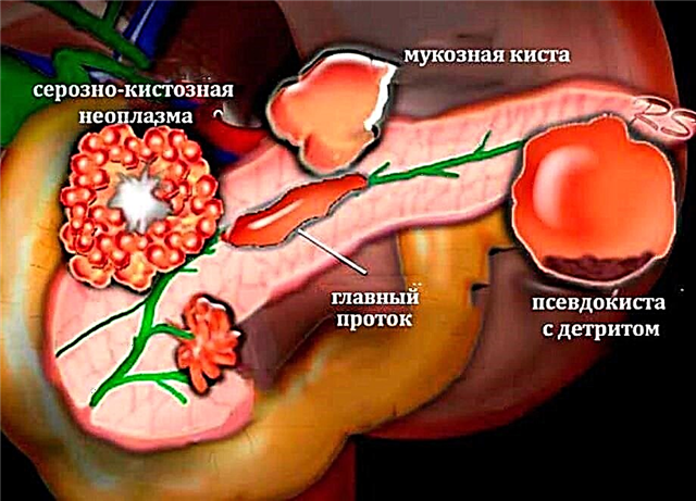 Curatio anorum remedia pancreaticum