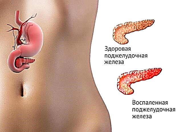 Na pancreatitis e shoa: lefu la lefu la pancreatic