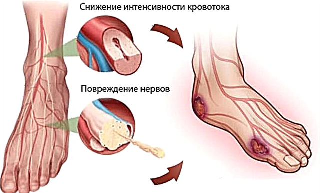 Kako i kako liječiti dijabetičko stopalo kod kuće: metode liječenja