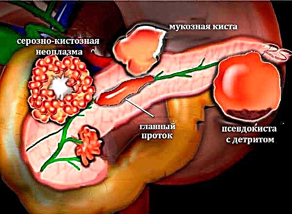 Paggamot at pagtanggal ng pancreatic cysts