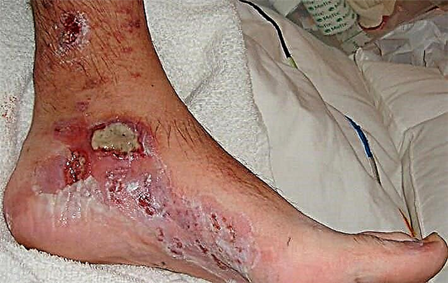 ذیابیطس کے پاؤں کی علامت: ابتدائی مرحلے کی روک تھام