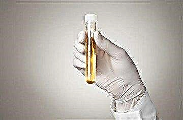 Owah-owahan ing analisis urin ing diabetes mellitus: warna, kapadhetan, anané protein, glukosa lan bahan liyane