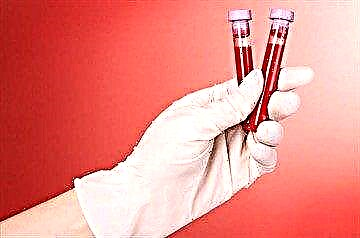 Предаваме биохемиски тест на крвта за глукоза во крвта: подготовка, толкување на резултатите и нормите