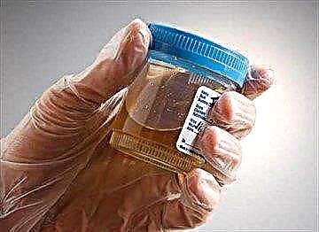 Acetone apparuit in urina inpuberis pueri - quid sibi vult?