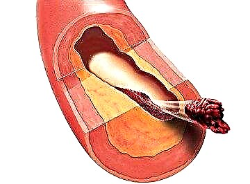 Shkaqet, rreziku dhe metodat e trajtimit për aterosklerozën në diabet