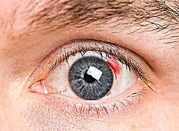 Komplikacije oka - dijabetička retinopatija: stadijumi, liječenje, prognoza