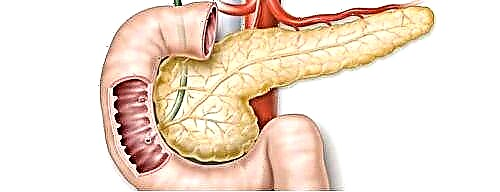 Pancreatic insulinoma