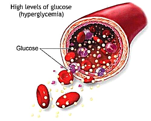 Чихрийн шижинтэй шээсэнд элсэн чихэр (глюкоз)