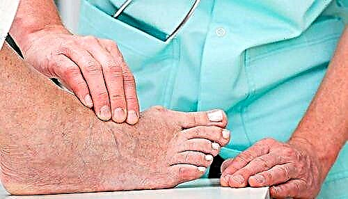 Rregullat për kujdesin e këmbëve për diabetin