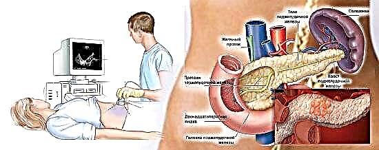 In genere, symptomata de morbo in mulieres pancreaticum