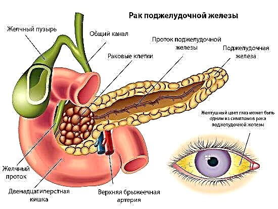 Ang cancer sa pancreatic