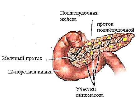 Pliigita ekogeniceco de la pankreato