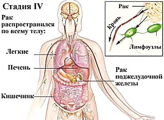 Pancreatic khansa siteji 4