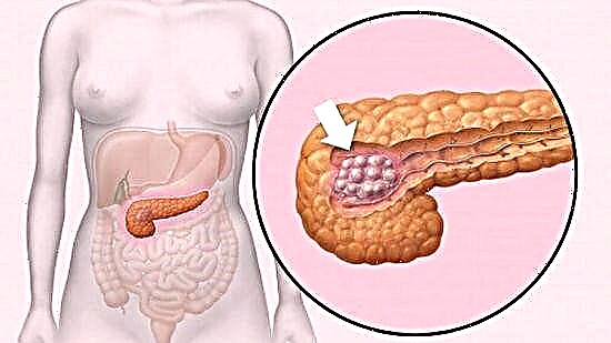 Onkologi pancreatik
