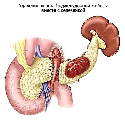 Operasi pancreas