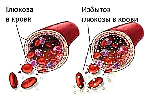 I-neuropathy yesifo sikashukela