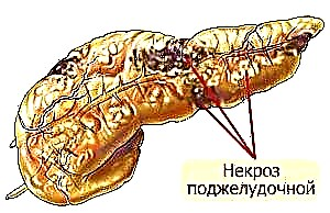 Pagkahuman human sa operasyon alang sa pancreatic pancreatic necrosis