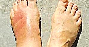 پاؤں کی بلغمی - ذیابیطس کی ممکنہ پیچیدگی