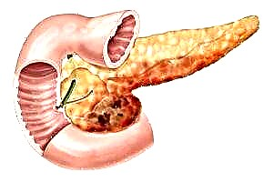Nyababkeun sareng akibat tina nekrosis pankreas hemorrhagic