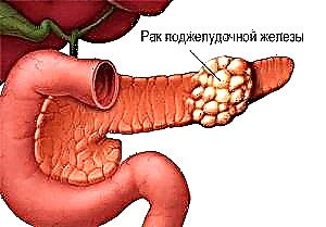 Pancreatic kanesa ola faamoemoe