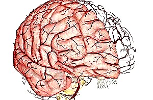 Cerebral atherosclerosis - ang panguna nga mga katalagman ug mga pamaagi sa pagtambal