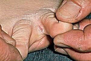 Uzroci i liječenje pukotina između nožnih prstiju