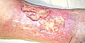 Venarum ulcera est curatio de diabete Mellitus aegris in inferiores partes