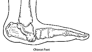 Shenjat dhe trajtimi i këmbës së Charcot në diabet