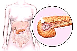 Zizindikiro ndi njira zochizira pancreatic cysts