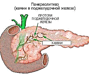Formatio gemmas pancreatis