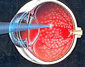 Чихрийн шижингийн ретинопатийн шинж тэмдэг ба эмчилгээ