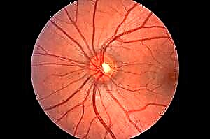 Entwécklung vun diabetescher retinal Angiopathie