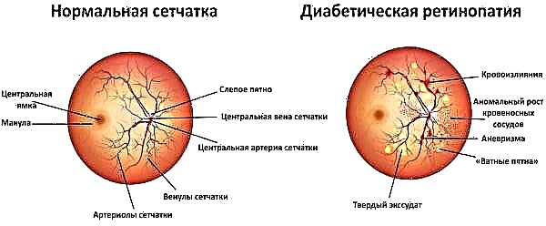Bayyanar cututtuka na retinopathy na ciwon sukari