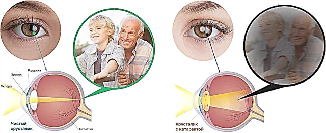 Deterioración e perda de visión na diabetes - tratamento e prevención