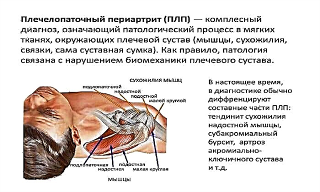 Форум лечение периартрита