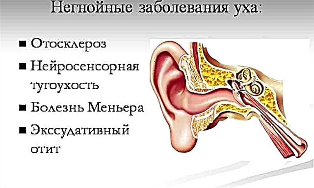 Нарушение среднего уха. Заболевания среднего уха. Болезни среднего уха отосклероз. Заболевания ушного молоточка отосклероз. Охарактеризуйте заболевания среднего уха..