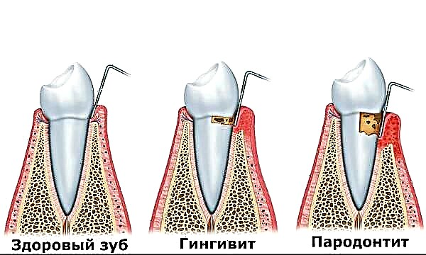 Parodontitis: uzroci, simptomi, liječenje i prevencija