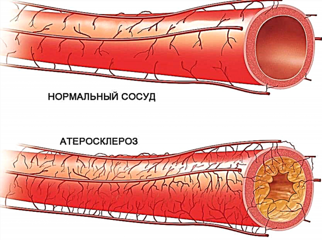 Atherosklerosis a Cholesterol Placke bei Diabetis